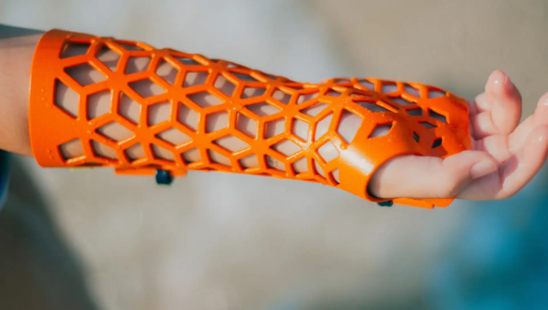 A finished orange Gero3D cast on a patient's forearm